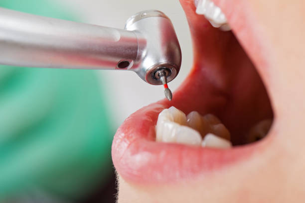 Best Emergency Wisdom Teeth Removal in Tower Lakes, IL